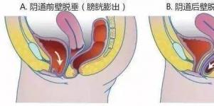 生了宝宝，我就阴道壁膨出了